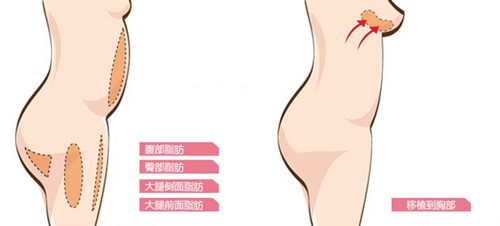 自體脂肪移植豐胸