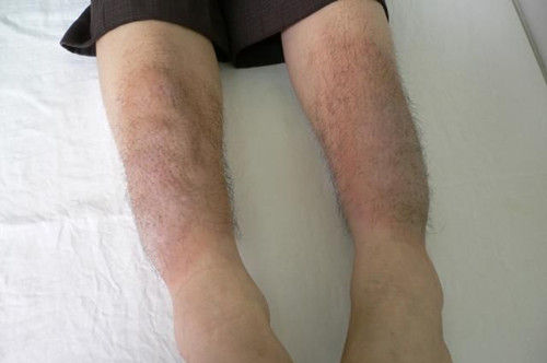 下肢水腫的鑒別診斷