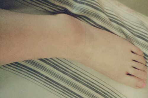 腳水腫瞭怎麼消腫 消腫方法介紹