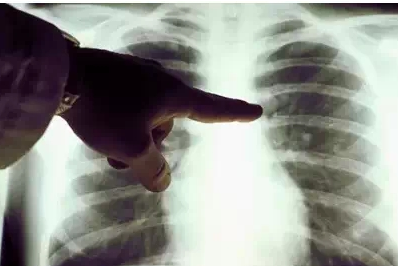 石棉肺是怎麼回事
