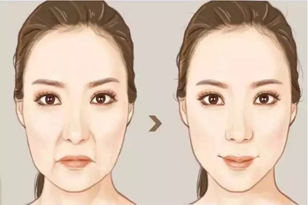 鼻唇溝紋怎麼去除
