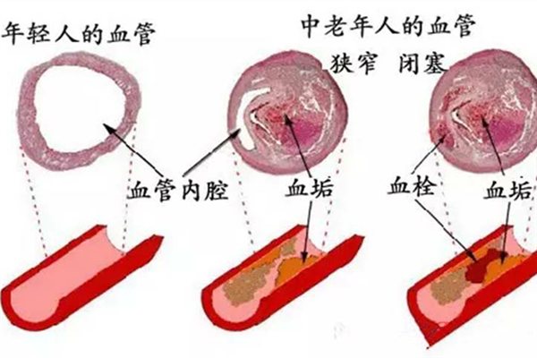 動脈粥樣硬化