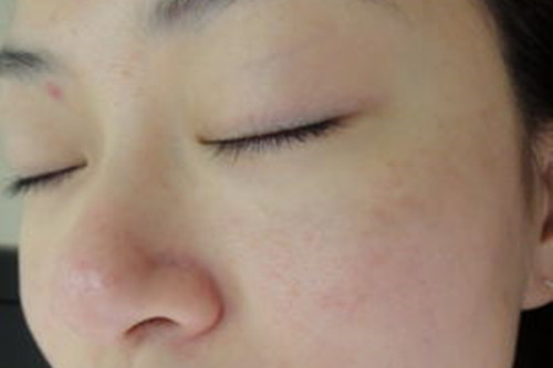 顴骨長斑的原因  什麼原因導致顴骨長斑