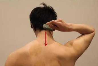 刮痧治療頸椎病_刮痧能治療頸椎病嗎_刮痧刮哪裡治療頸椎病_治療頸椎病的刮痧法