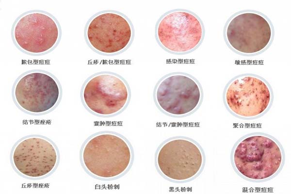 幾種常見瘡的治療方法