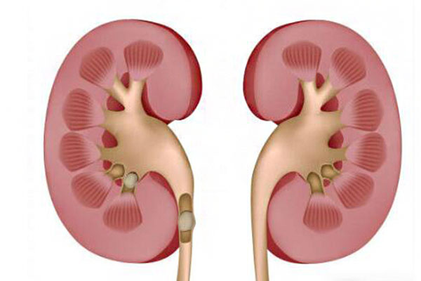 腎囊腫是怎麼回事_腎囊腫癥狀_腎囊腫的最佳治療方法