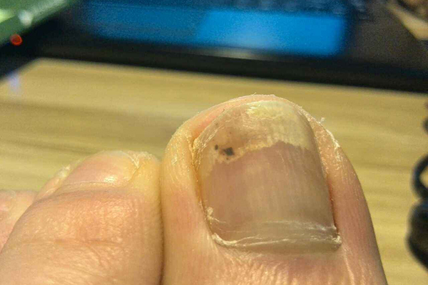  自己治療灰指甲的土方法