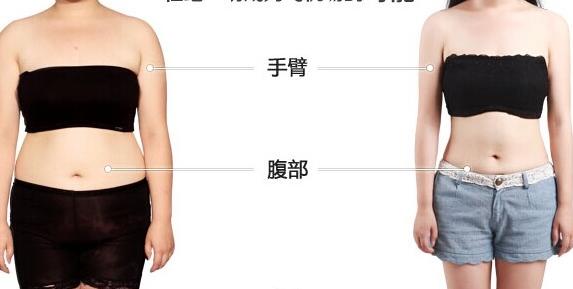 吸脂塑身