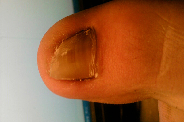 治療灰指甲的小竅門