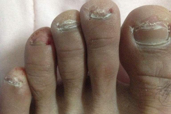 灰指甲的原因  不治的後果