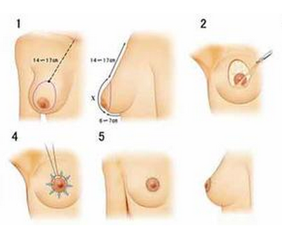 乳房下垂整形安全嗎
