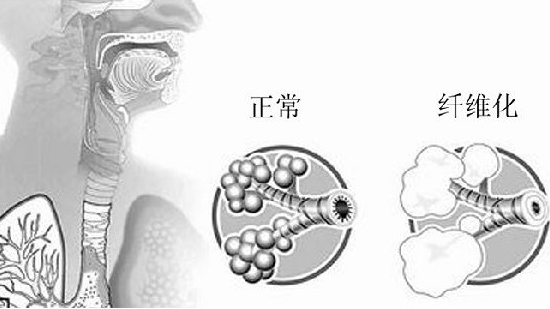 肺纖維化該怎麼調養