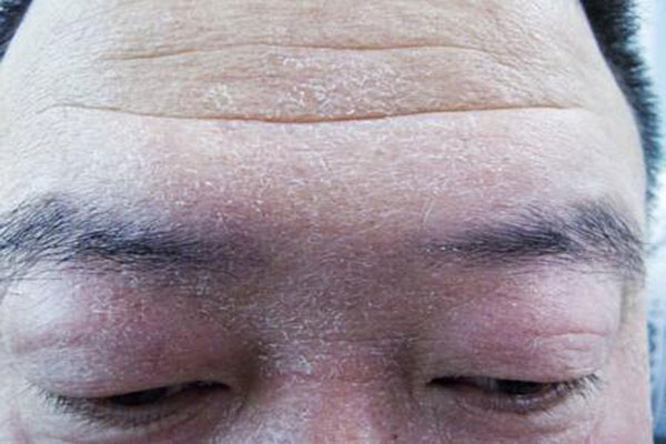 汗斑怎麼治_汗斑的最佳治療方法_汗癬圖片