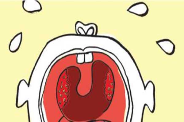 會厭炎是怎麼回事？會厭炎的癥狀及治療