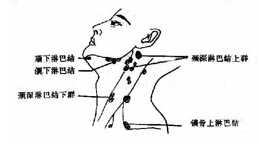 淋巴管閉塞癥的危害