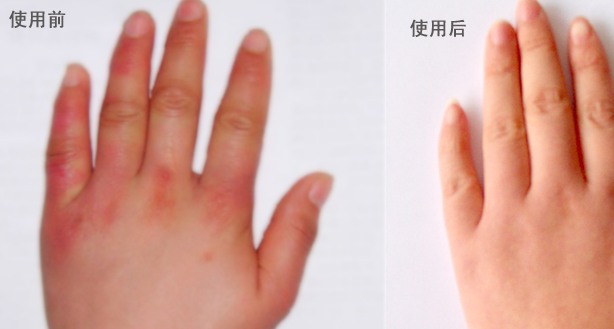 消腫止痛的秘方