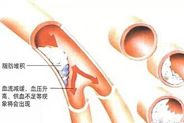 血脂高應註意什麼怎麼辦_血脂高的原因_癥狀