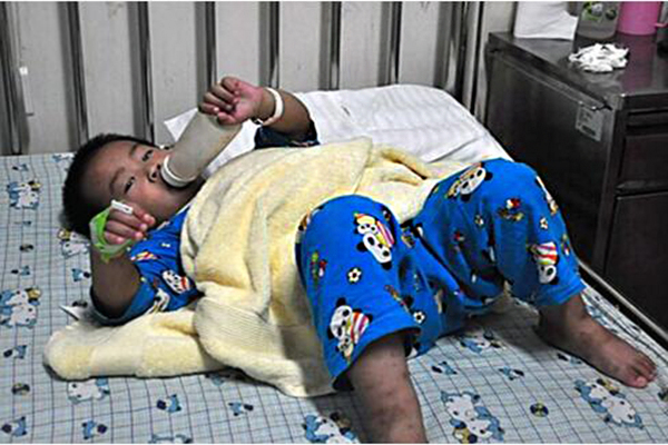 小孩腎病綜合征能活多久_兒童腎病綜合征能治愈嗎