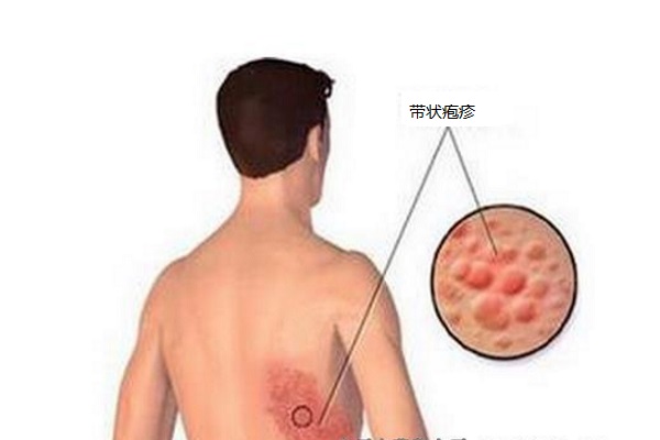蜘蛛瘡簡介 蜘蛛瘡怎麼治