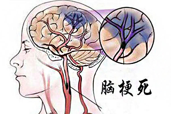多發性腦梗塞的癥狀_腦梗塞最佳治療時間_吃什麼食物好 多發性腦梗塞的癥狀_腦梗塞最佳治療時間_吃什麼食物好