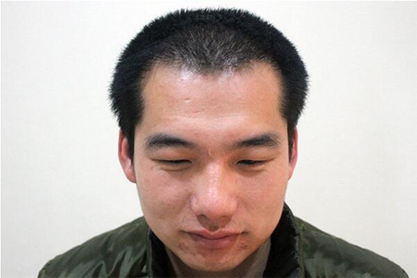 脫發的原因有哪些