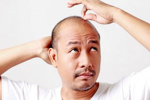 男性脫發是什麼原因