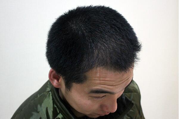 脫發過多是由什麼原因導致的