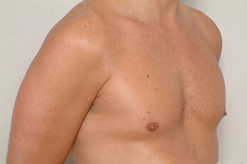 男性乳房發育
