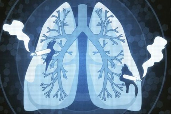 肺癌早期癥狀_肺癌的預防