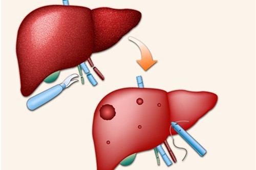 肝癌的危害有哪些你瞭解嗎?
