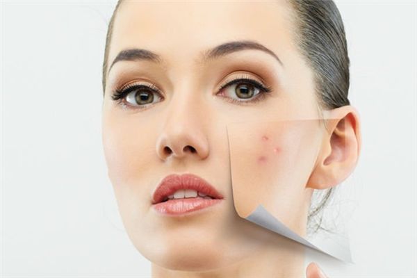 粉刺增多小心肝不好