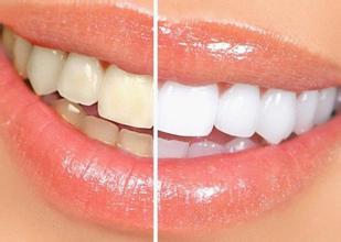 冷光牙齒美白有什麼優勢 冷光牙齒美白多少錢