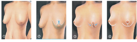 不同時期 怎麼防止胸下垂