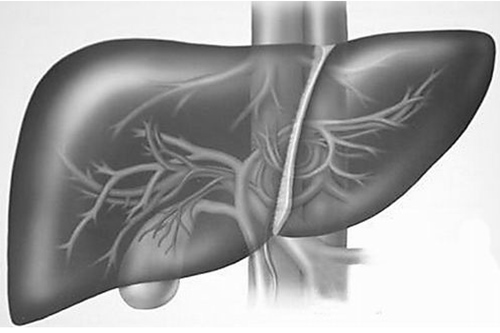 肝囊腫的病因 先天性膽管發育不良