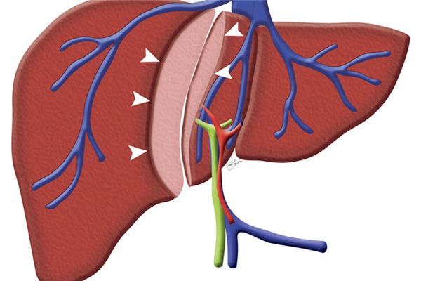 肝囊腫引起的原因_肝囊腫怎麼治 肝囊腫