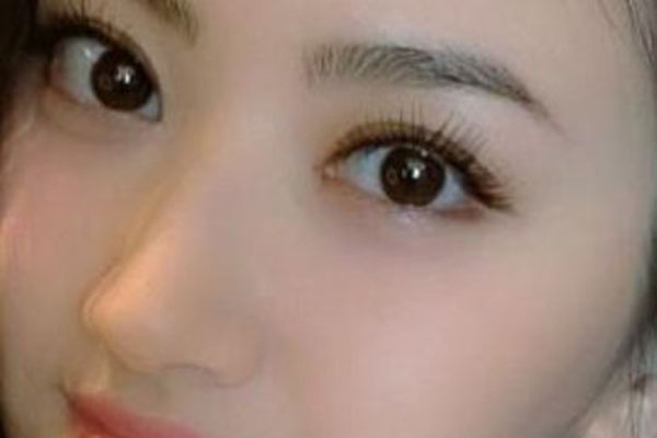 臥蠶和眼袋的區別是什麼 如何治療呢 臥蠶和眼袋的區別是什麼 如何治療呢