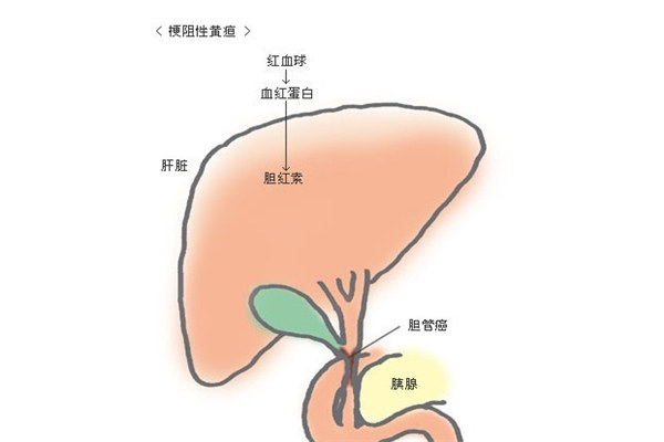 急性膽囊炎怎麼辦_急性膽囊炎的癥狀