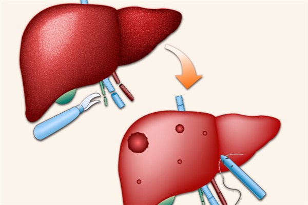 乙肝癥狀_乙肝如何預防 乙肝