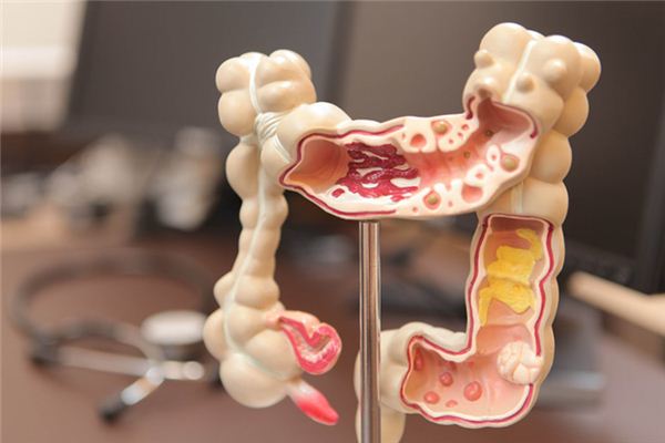 結腸癌的原因_結腸癌早期癥狀 大腸癌