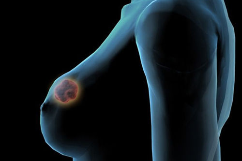 你知道乳腺癌患者的晚期表現嗎?