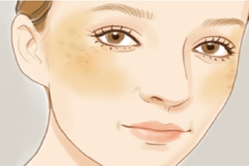 拒絕產後妊娠斑 漂亮媽媽吃出來