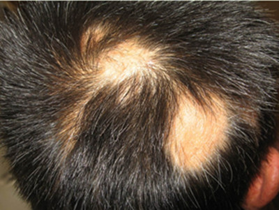 如何治療斑禿 治療斑禿的方法