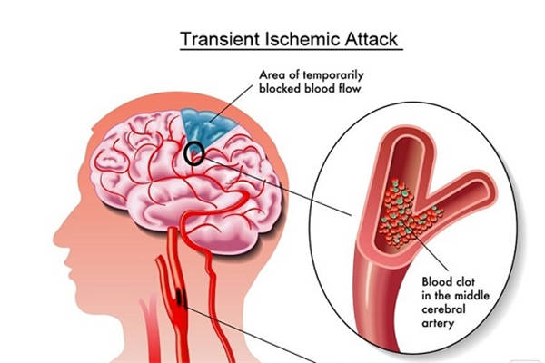 腦梗塞後期康復治療_吃什麼_怎麼辦