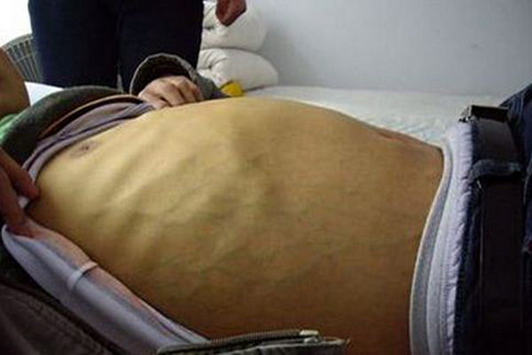 肝硬化腹水早期癥狀_怎樣治療_肝硬化腹水還能活多久_會死嗎 肝硬化腹水早期癥狀_怎樣治療_肝硬化腹水還能活多久_會死嗎