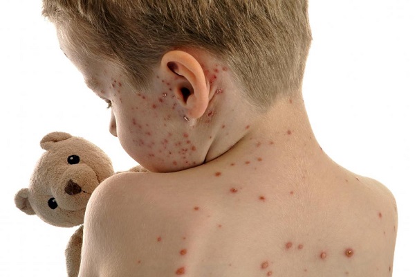 帶狀皰疹是怎麼引起的 帶狀皰疹怎麼治療 帶狀皰疹的治療方法