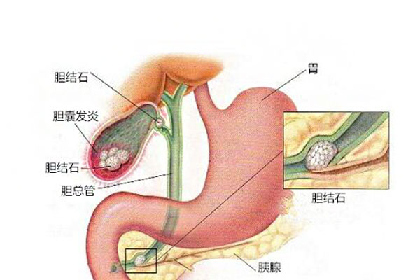 膽囊切除後的飲食_膽囊切除後遺癥_除術後綜合征