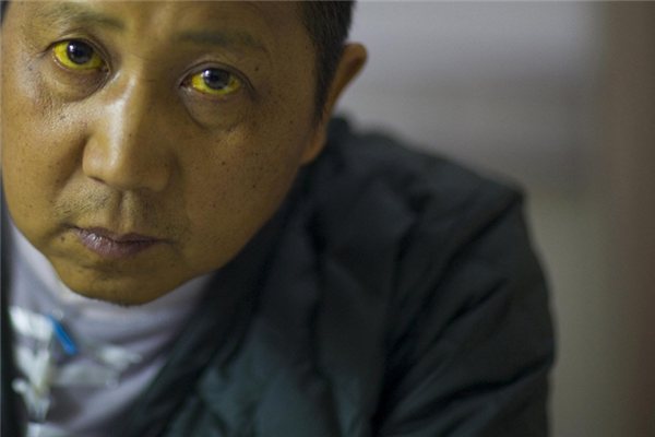 黃疸指數正常值_黃疸是什麼