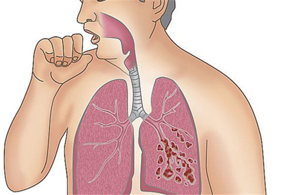 肺癌患者的照顧_護理_飲食_交流方法