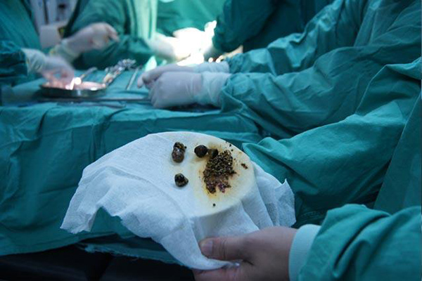 膽囊炎吃什麼好_膽囊炎的飲食_食療_不能吃什麼