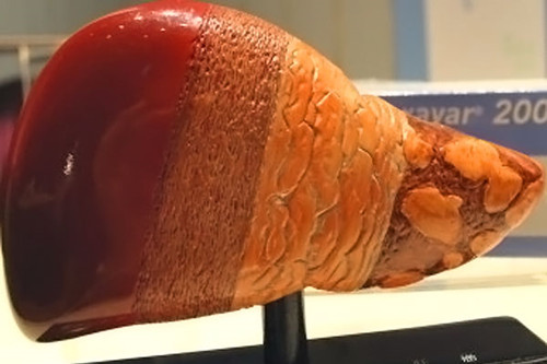 肝癌很可怕 四類人要警惕